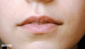 REGENYAL IDEA Lips